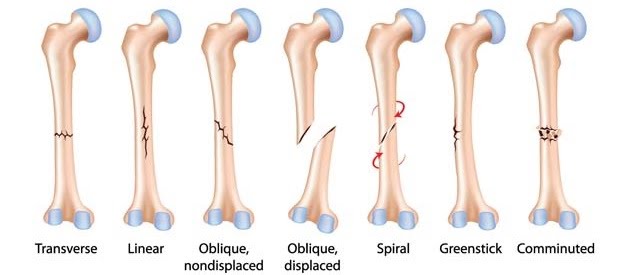 The skeleton and fractures | The A Level Biologist - Your Hub