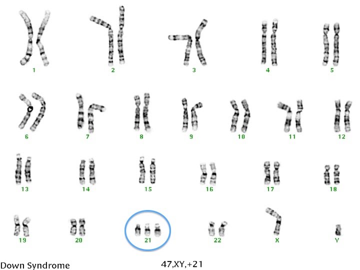 Gene Mutation In Sickle Cell Anaemia And Chromosome Mutation In Downs