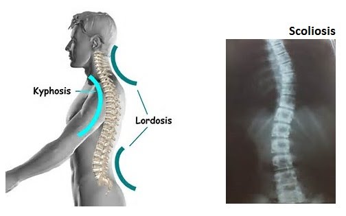 Vertebrae and deformities | The A Level Biologist - Your Hub