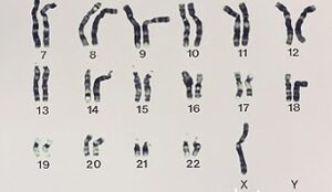 Down’s syndrome, Turner’s syndrome and Klinefelter’s syndrome | The A ...